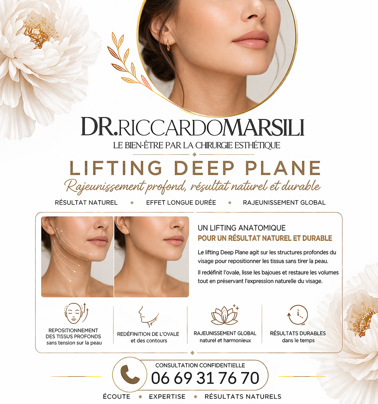 Le lifting deep plane sur Paris 16