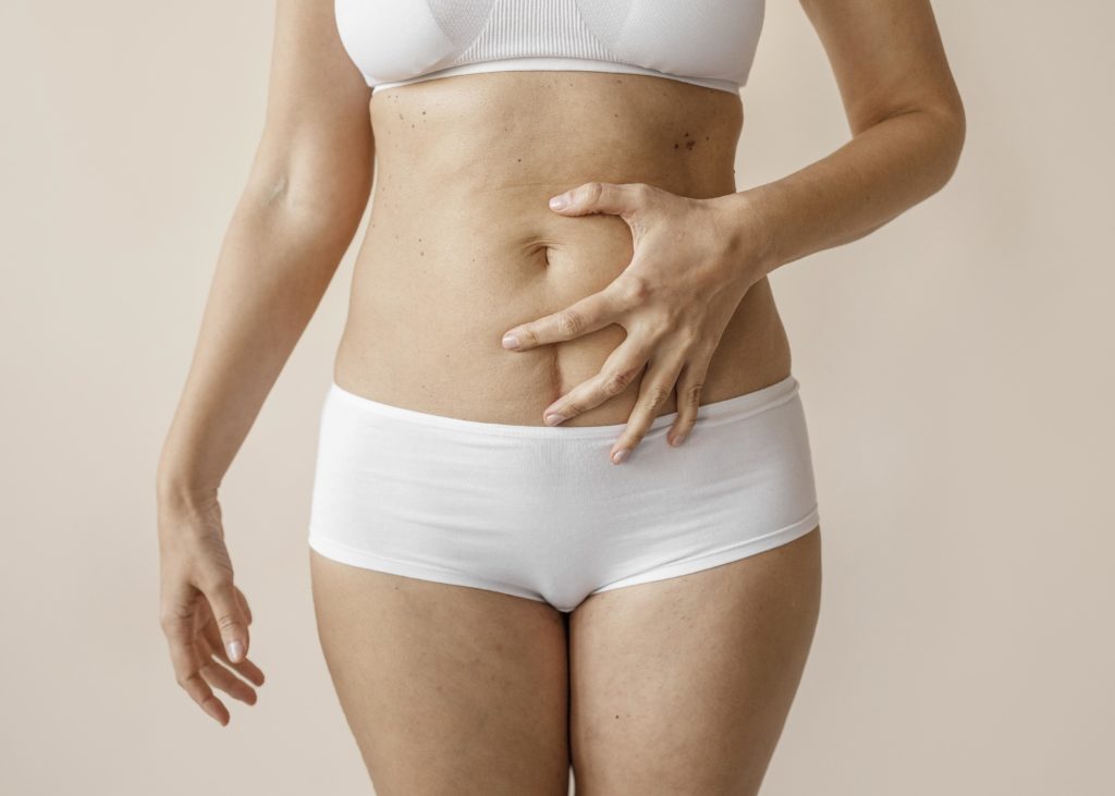 Résultat après abdominoplastie